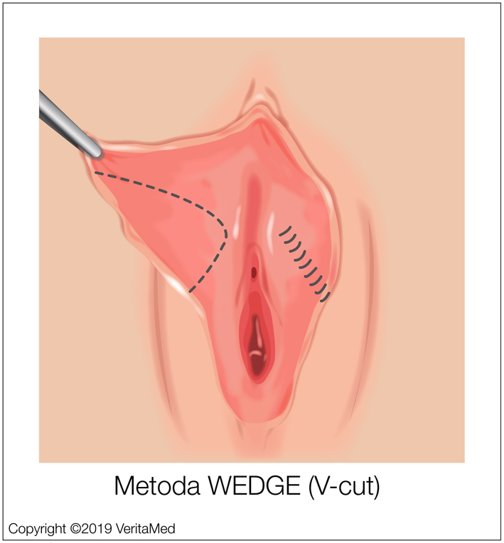 Labioplastyka - Metoda WEDGE (V-cut) - VeritaMed.jpg